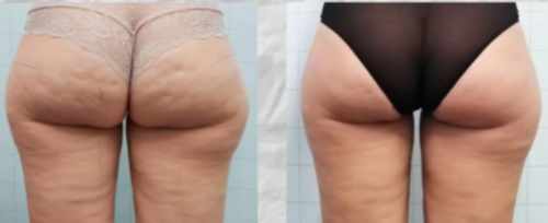 G5 Cellulite Massage Vergleich